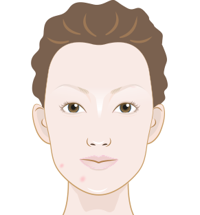 Pickel zwischen den Augenbrauen - So wirst du sie los