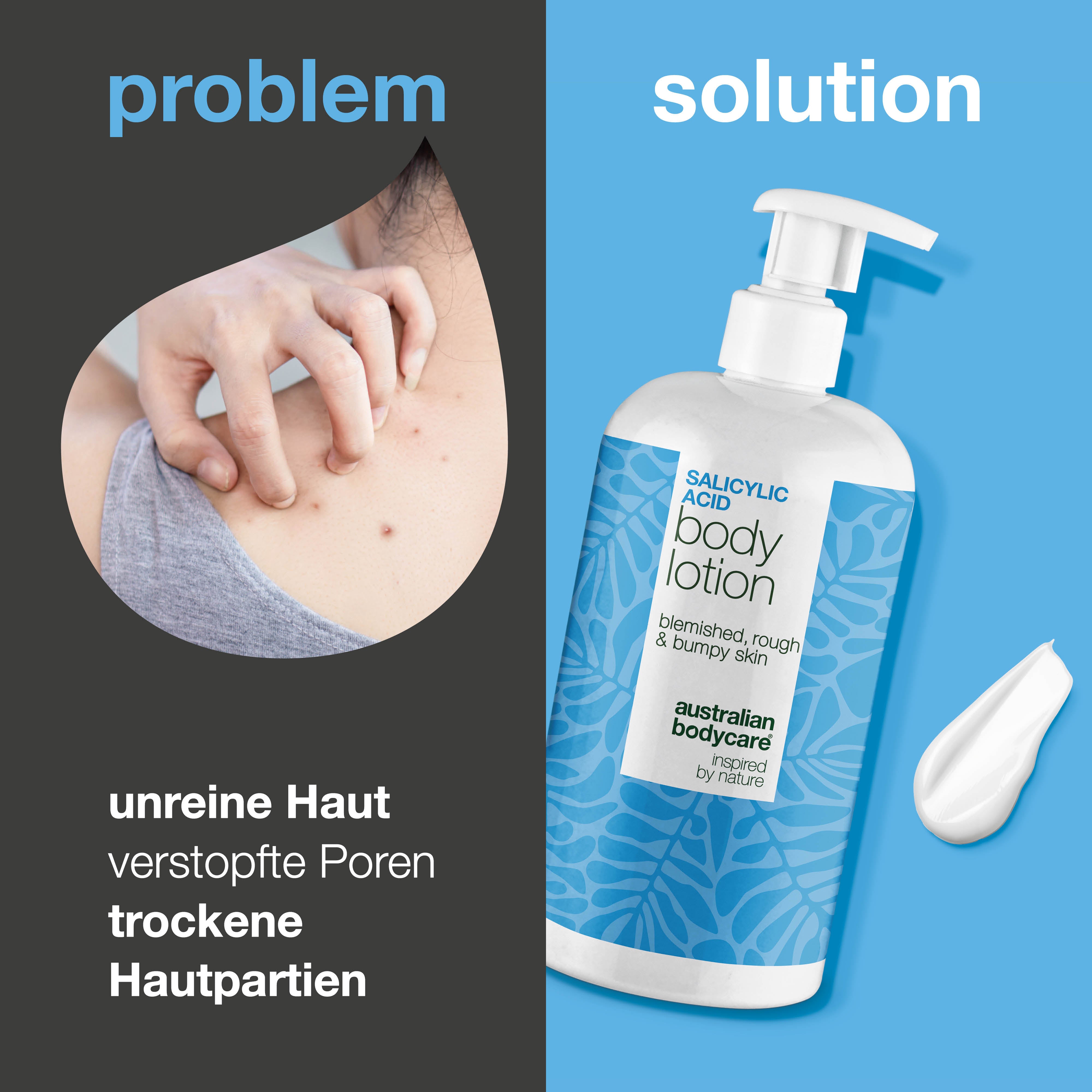 Körperlotion mit Salicylsäure – für trockene und raue Haut — Körperlotion mit Salicylsäure exfoliert sanft, spendet Feuchtigkeit und sorgt für eine glatte, weiche Haut. Ideal für die tägliche Pflege.