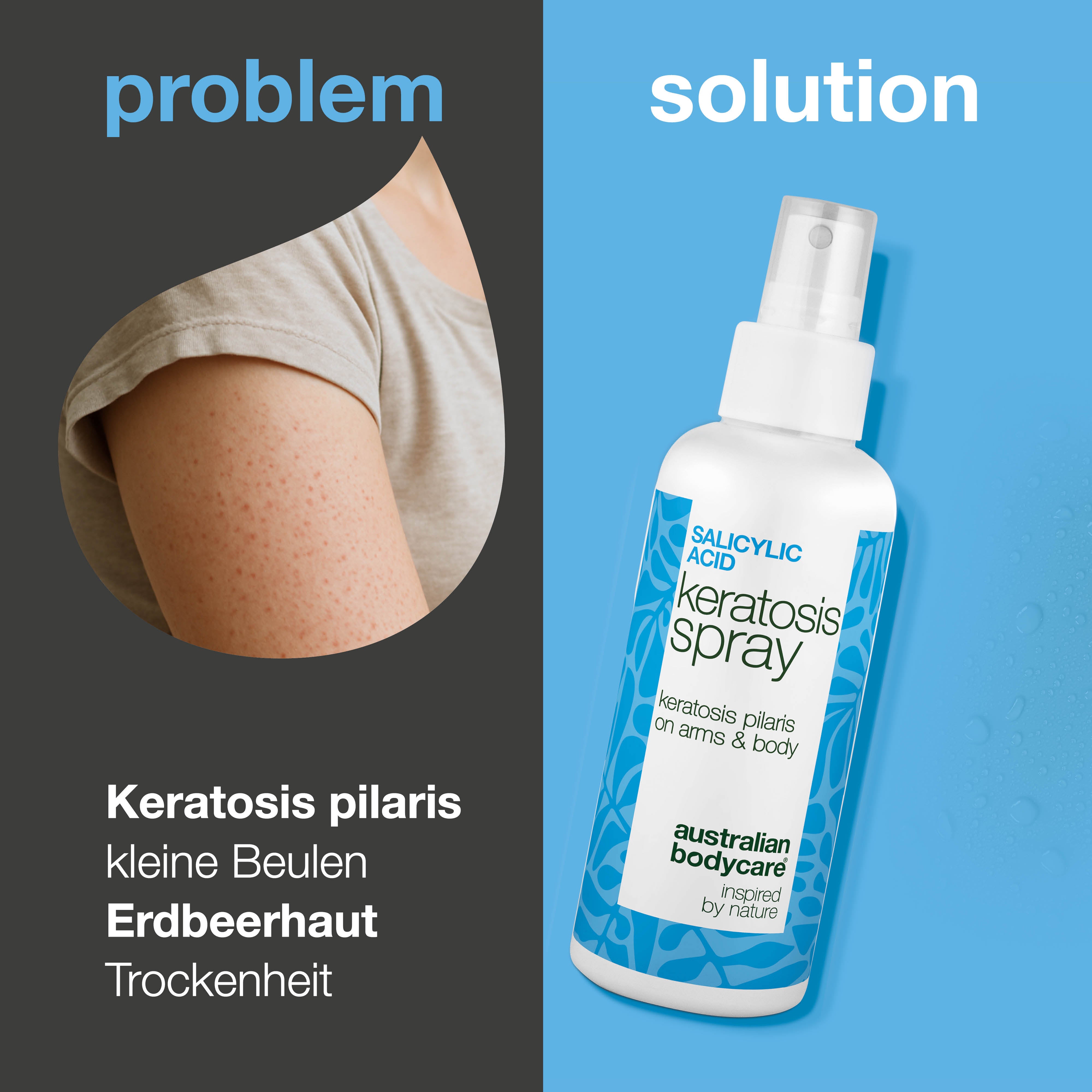 Spray bei Keratosis Pilaris und Reibeisenhaut an Armen und Beinen — Keratosis Pilaris Spray glättet raue Haut und Pickelchen. Mit Salicylsäure zur sanften, tiefenwirksamen Exfoliation.