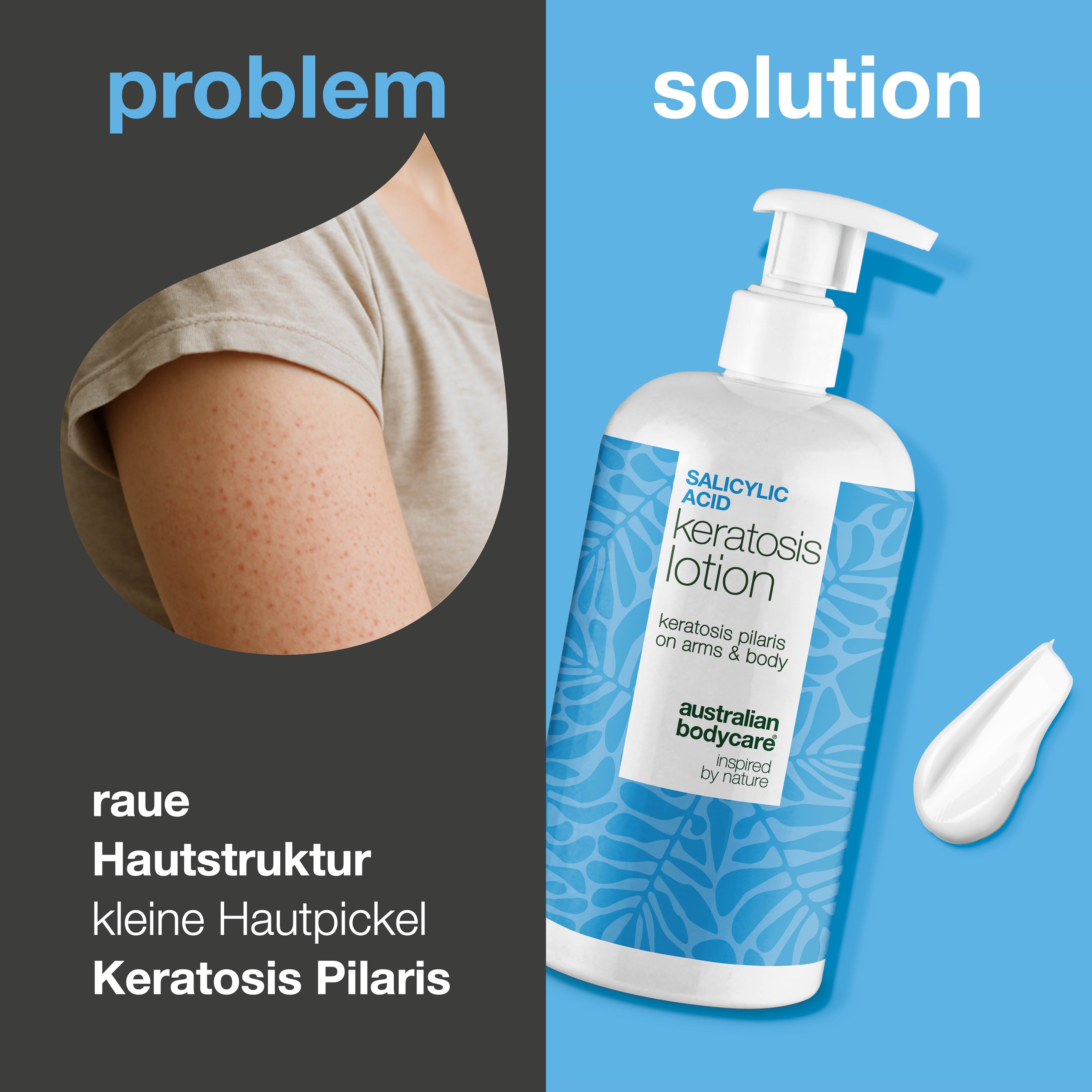Body Lotion bei Keratosis Pilaris & Reibeisenhaut — Body lotion gegen Keratosis Pilaris. Glättet mit Salicylsäure, Niacinamid und Zink. Für raue, trockene Haut.