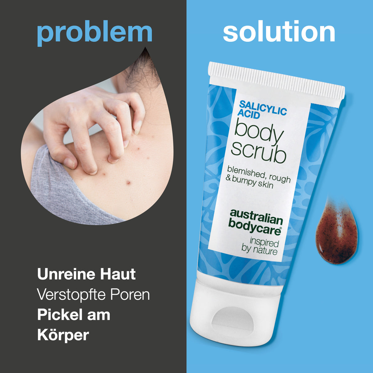 Problem und Lösung: Pickel am Körper, verstopfte Poren und unebene Haut. Links eine Nahaufnahme einer Schulter mit Pickeln, rechts der Salicylic Acid Body Scrub von Australian Bodycare
