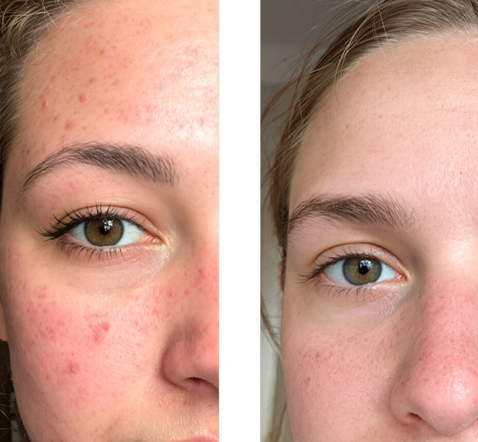 Vorher/Nachher-Bild eines Kunden bei der Anwendung unseres 2% Salicylic Acid Face Toners/Peelings/Exfoliants, das eine große Verbesserung der Haut mit weniger Pickeln und Unreinheiten zeigt.