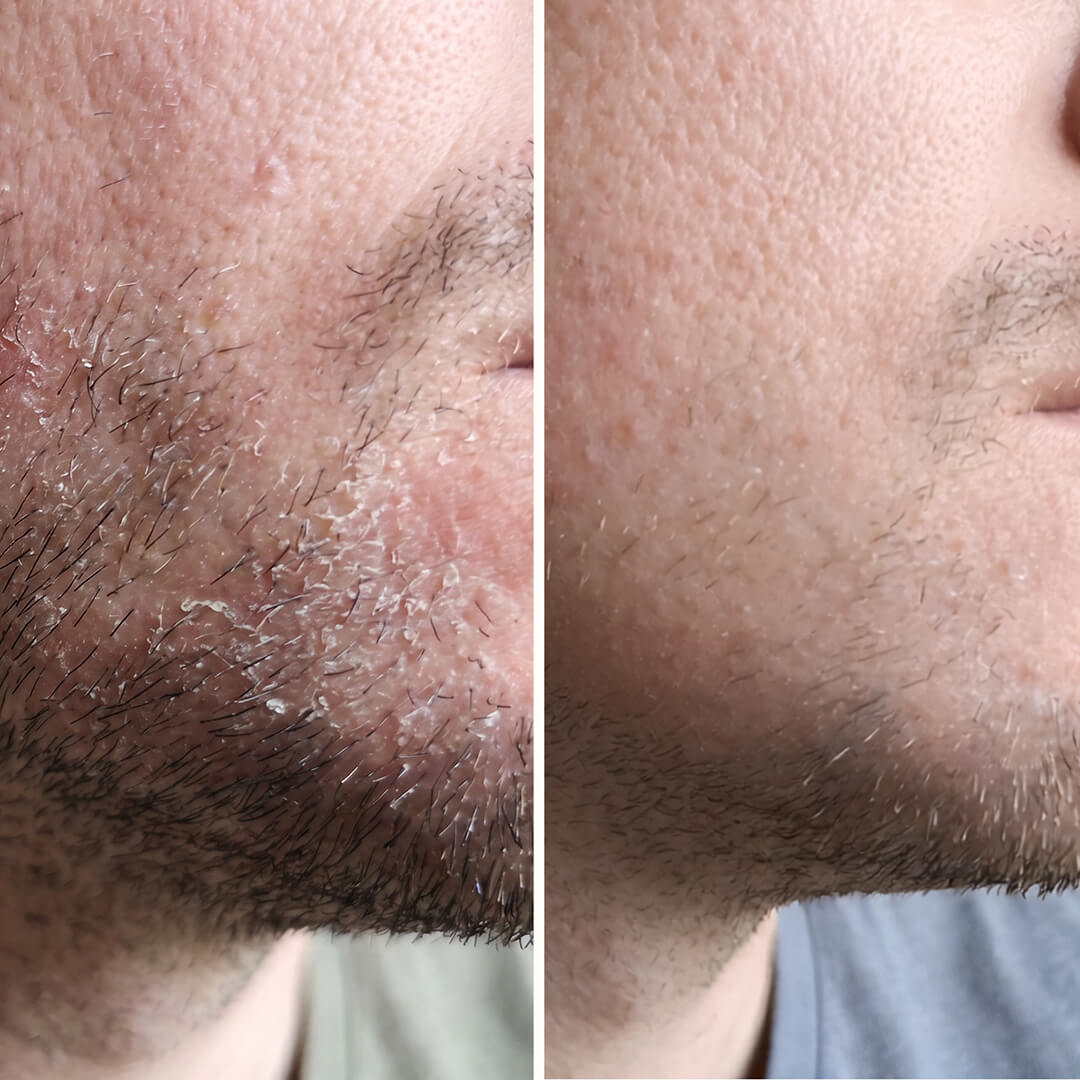 Salicylsäure Serum – Gegen Schuppen im Gesicht & Bart — Effektives Serum gegen Schuppen im Gesicht und Bart. Salicylsäure entfernt Schuppen und Rötungen für eine Haut in gesundem Gleichgewicht.