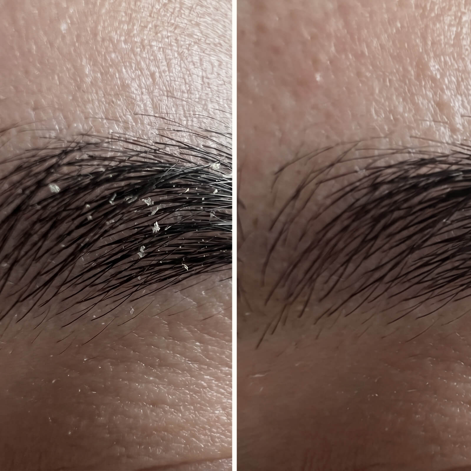 Salicylsäure Serum – Gegen Schuppen im Gesicht & Bart — Effektives Serum gegen Schuppen im Gesicht und Bart. Salicylsäure entfernt Schuppen und Rötungen für eine Haut in gesundem Gleichgewicht.