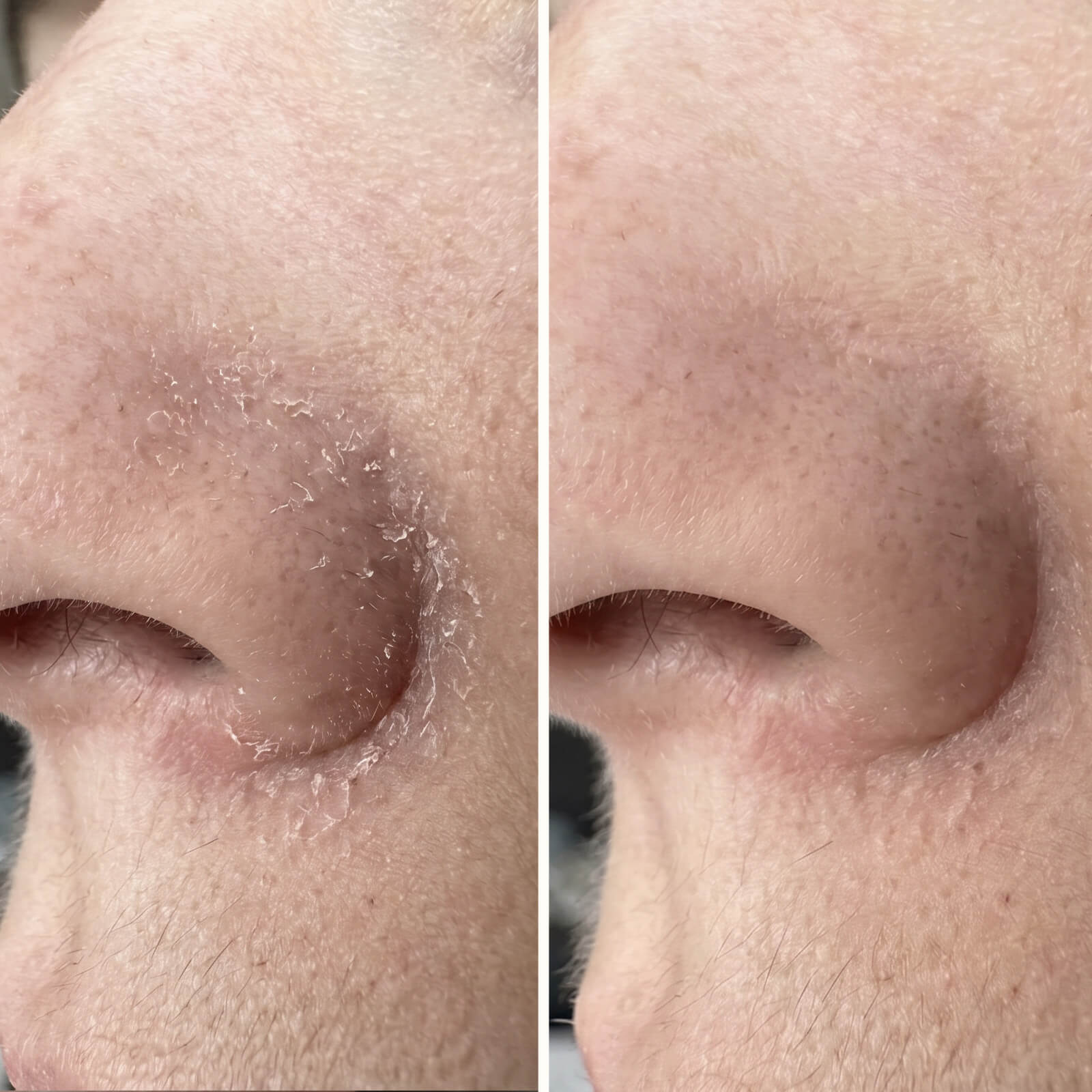 Salicylsäure Serum – Gegen Schuppen im Gesicht & Bart — Effektives Serum gegen Schuppen im Gesicht und Bart. Salicylsäure entfernt Schuppen und Rötungen für eine Haut in gesundem Gleichgewicht.