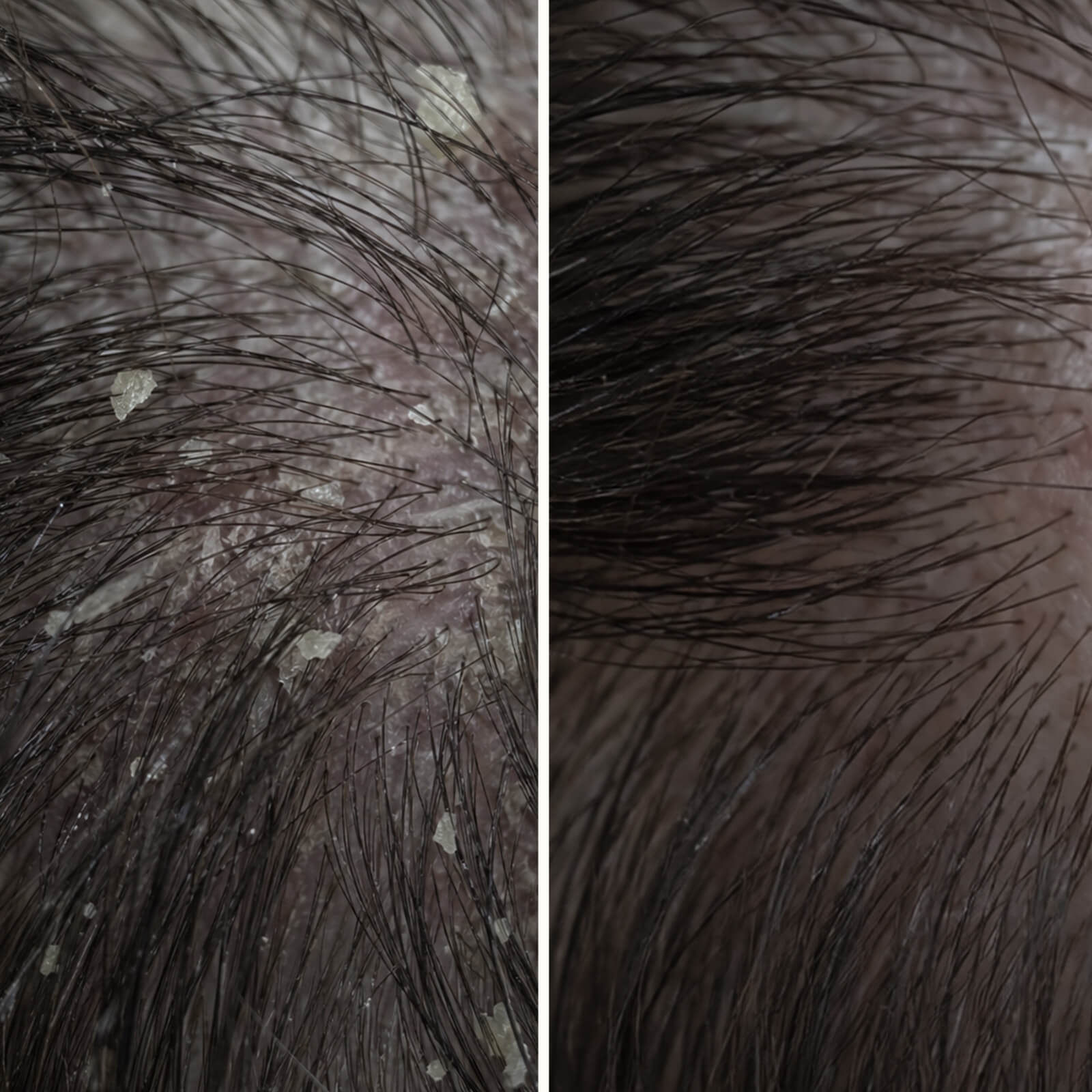 Salicylsäure Kopfhautpeeling gegen Schuppen und Juckreiz — Salicylsäure Kopfhautpeelling lindert Juckreiz, Schuppen und Fett. Vor der Wäsche anwenden für tiefe Exfoliation mit aktiver Salicylsäure.