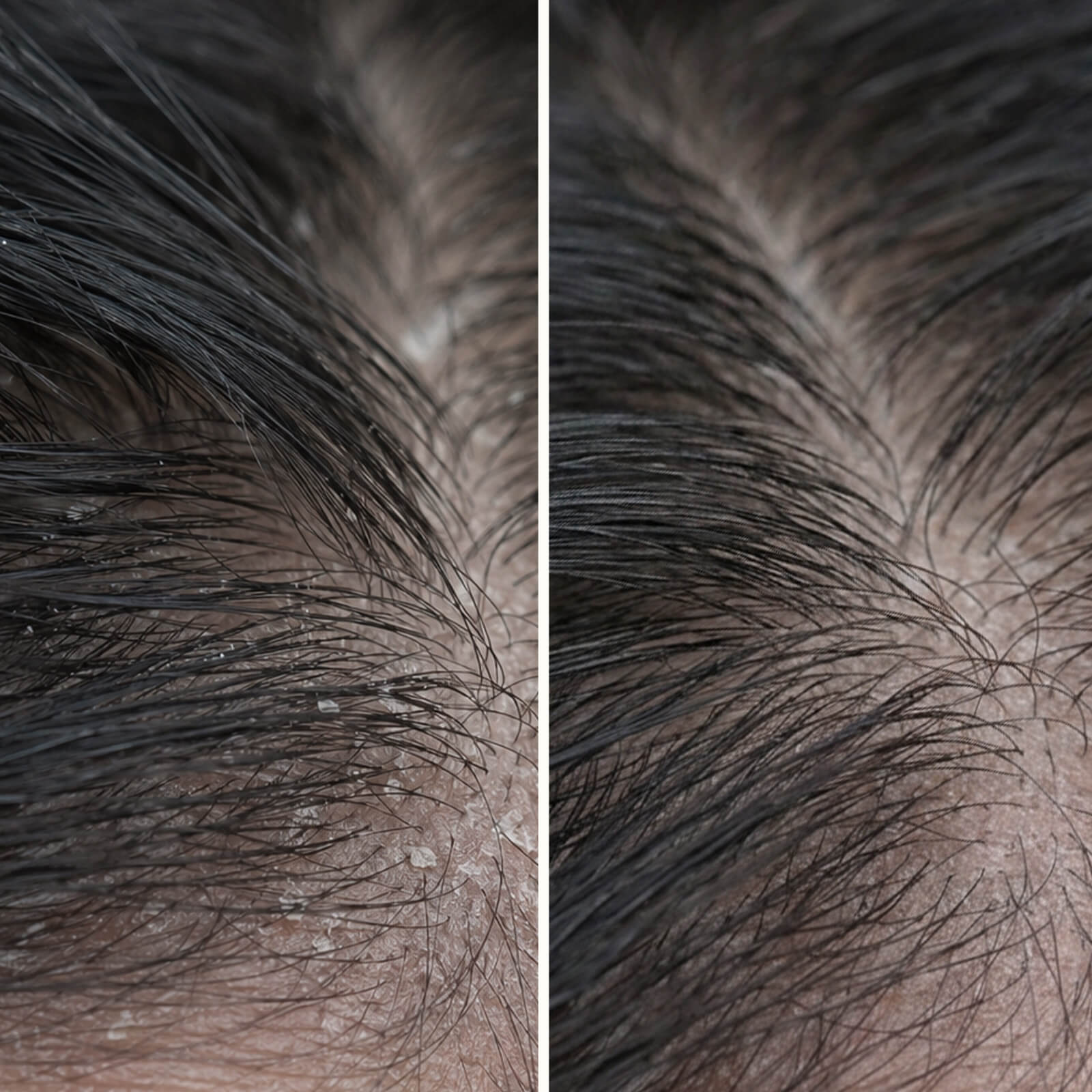 Salicylsäure Kopfhautpeeling gegen Schuppen und Juckreiz — Salicylsäure Kopfhautpeelling lindert Juckreiz, Schuppen und Fett. Vor der Wäsche anwenden für tiefe Exfoliation mit aktiver Salicylsäure.