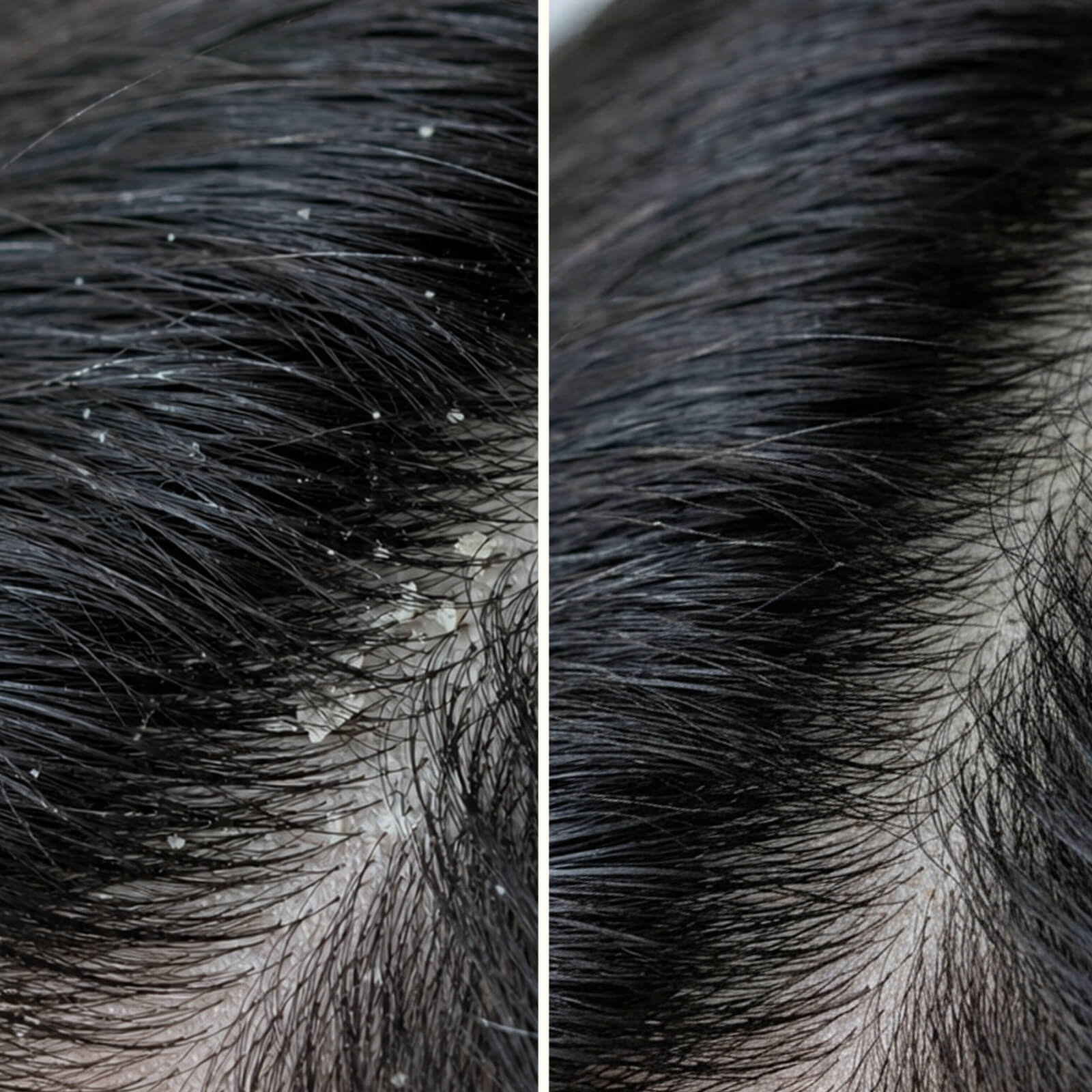 Salicylsäure Shampoo gegen Schuppen & Juckreiz — Schluss mit juckender Kopfhaut und Schuppen. Beruhigt trockene Haut und entfernt abgestorbene Hautzellen mit Salicylsäure.