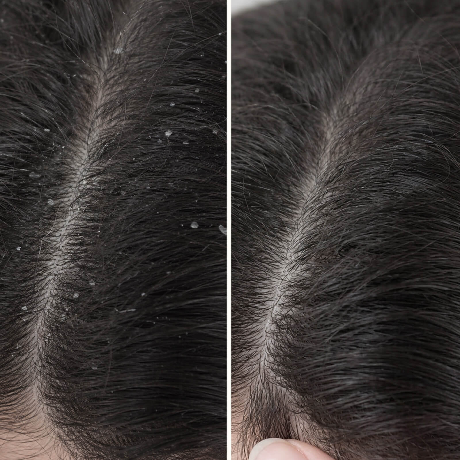 Salicylsäure Conditioner gegen Schuppen & Juckreiz — Conditioner mit Salicylsäure gegen Schuppen und Juckreiz. Hydratisiert die Kopfhaut und stärkt das Haar. Mit effektiver Salicylsäure.