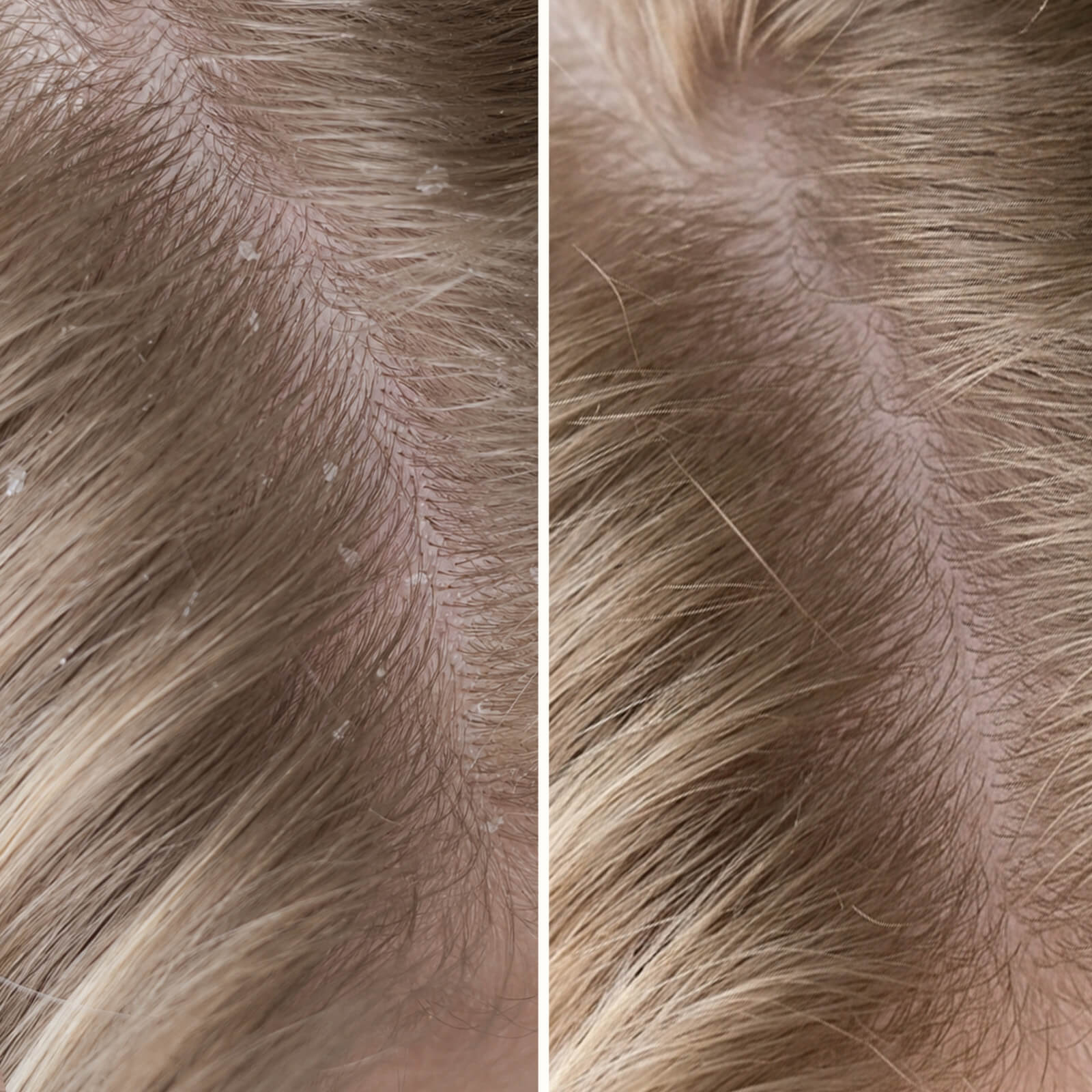 Salicylsäure Shampoo gegen Schuppen & Juckreiz — Schluss mit juckender Kopfhaut und Schuppen. Beruhigt trockene Haut und entfernt abgestorbene Hautzellen mit Salicylsäure.