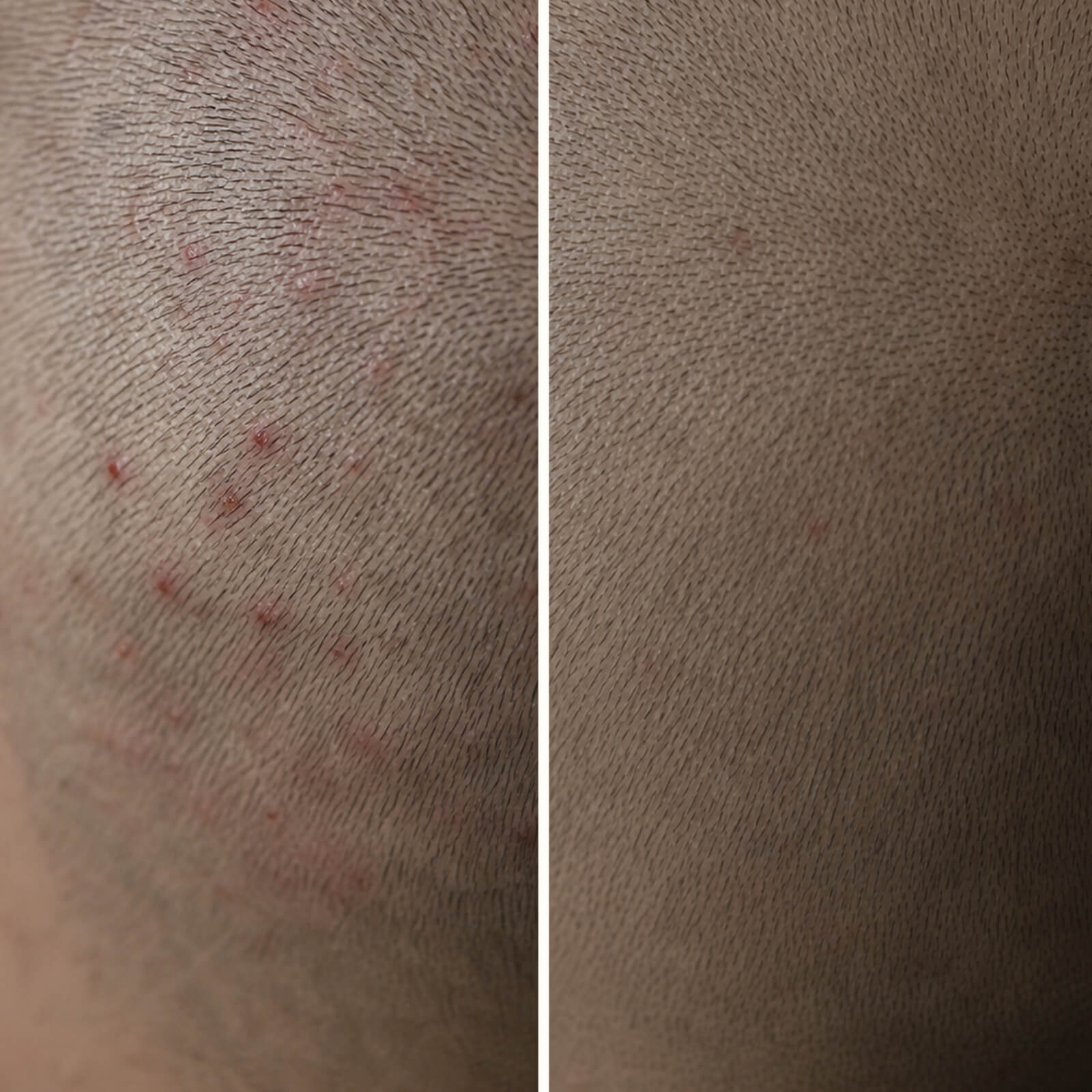 Salicylsäure Anti-Pickel-Kopfhautgel — Hilft bei Pickeln & Juckreiz auf der Kopfhaut! Salicylsäure peelt Poren, reduziert Talg und beruhigt rote, schmerzhafte Stellen effektiv.