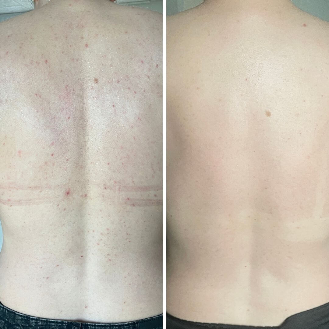 Vorher-nachher-Bild eines Rückens mit sichtbaren Pickeln und Akne auf dem „Vorher“-Foto und einem klaren, glatten Rücken ohne Unreinheiten nach 4-wöchiger konsequenter Anwendung des Australian Bodycare Salicylsäure Body Spray.