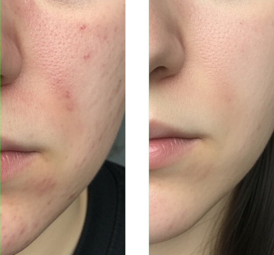 Vorher/Nachher-Bild eines Kunden bei der Anwendung unseres Salicylic Acid Cleansers, das eine große Verbesserung der Haut mit weniger Pickeln und Unreinheiten zeigt.