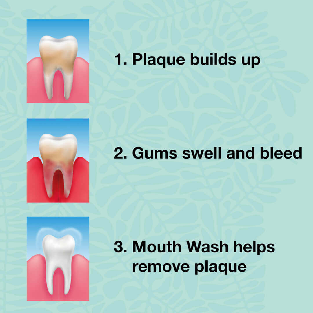 2 Mundspülungen gegen Mundgeruch, Parodontitis & Gingivitis - Für die tägliche Pflege bei Pilz und Zahnfleischentzündung
