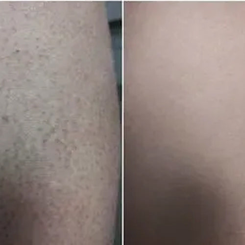 Alenas Ergebnis nach 2 Wochen mit dem Keratosis Pilaris Behandlungsset