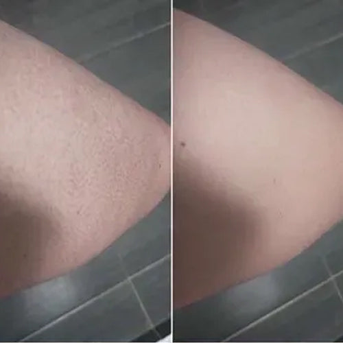 Keratosis Pilaris vorher und nachher – glattere Haut nach 2 Wochen