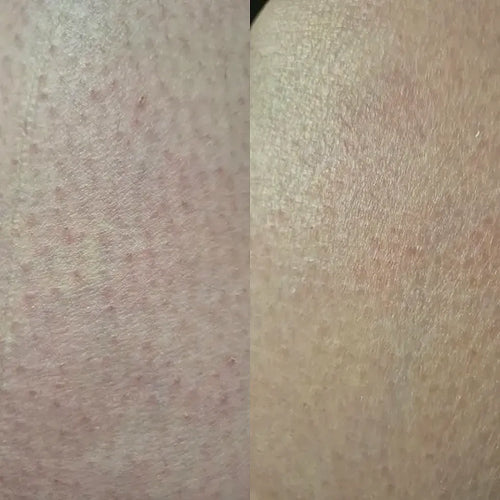 Nahaufnahme nach Keratosis Pilaris Behandlung – Carolins Ergebnis