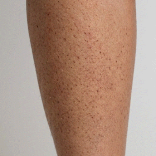 Nahaufnahme Keratosis Pilaris – kleine raue Knötchen an den Oberarmen