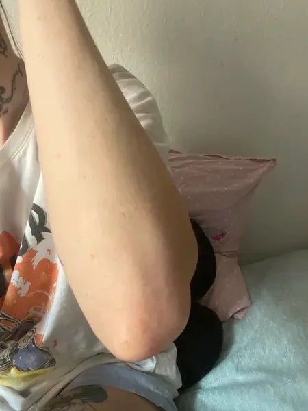 Kundenergebnis Keratosis Pilaris – Lisa A.