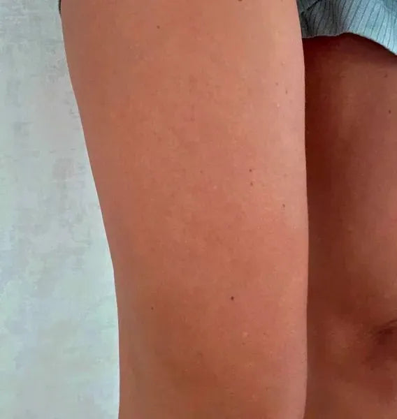 Kundenergebnis Keratosis Pilaris – Sarah S.