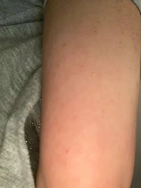 Kundenergebnis Keratosis Pilaris – Shaian H. verwendet Australian Bodycare