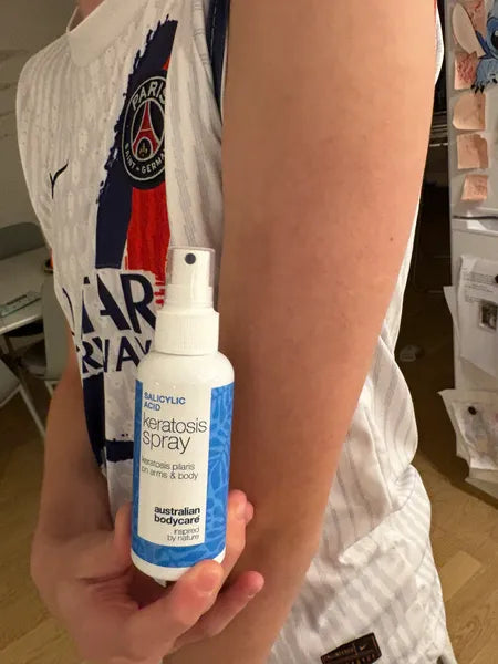 Kundenergebnis Keratosis Pilaris – 70% weniger Knötchen nach 3 Wochen
