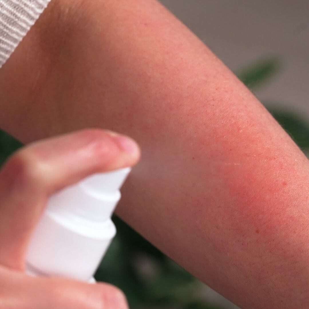 Spray gegen Juckreiz am körper, rücken und arme - Beruhigendes und Juckreiz linderndes Spray bei gereizter Haut